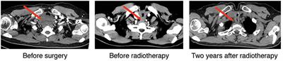 Primary Adenoid Cystic Carcinoma of the Upper Anterior Mediastinum Mimicking a Thyroid Tumor: A Case Report and Review of Literature